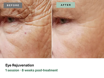 Fibroblast-Eye-Rejuvenation.png