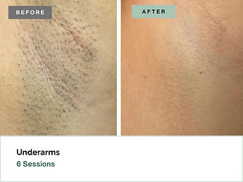 LaserHairRemoval-Oviedo-40E-Underarm.jpg