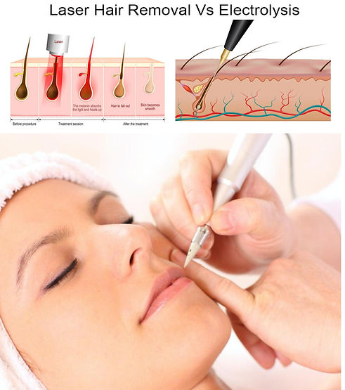 hair-removal-electrolysis01600.jpg