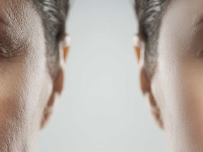 Why One Treatment Is Rarely the Answer to Facial Rejuvenation