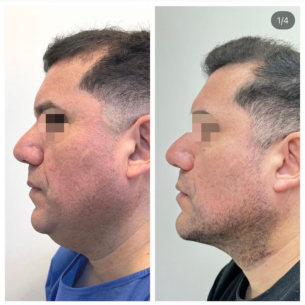 Miniatura: Liposucción de papada + Contorno mandibular