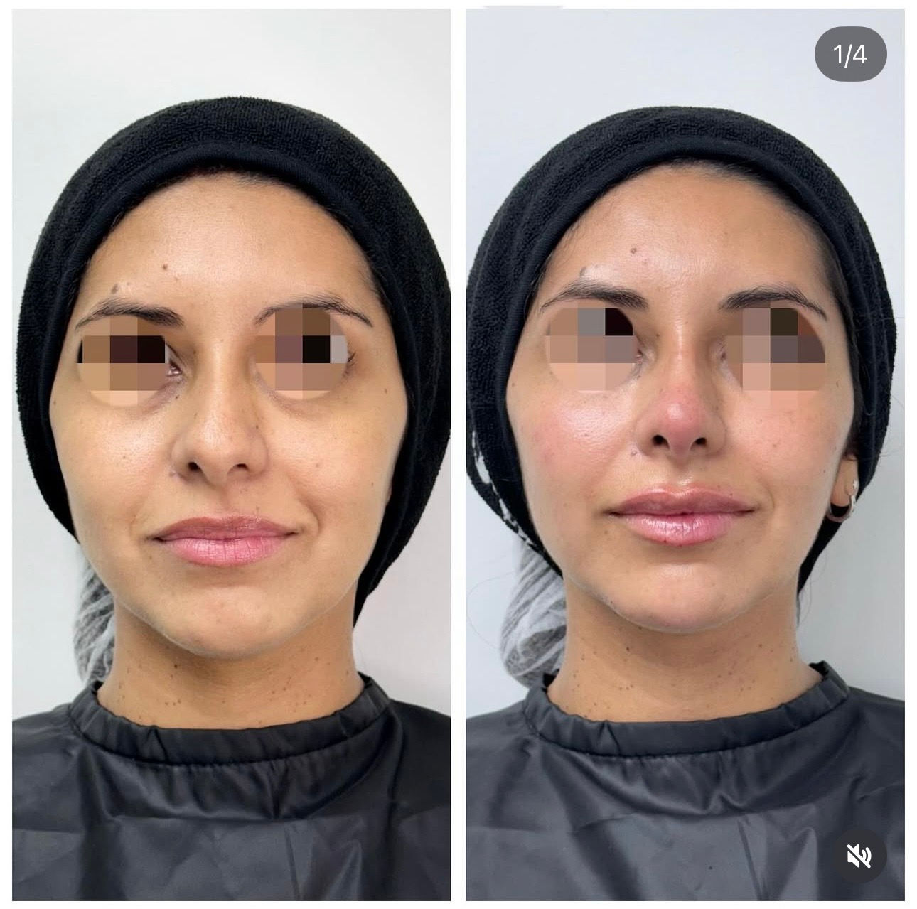 Full Face con ácido hialurónico