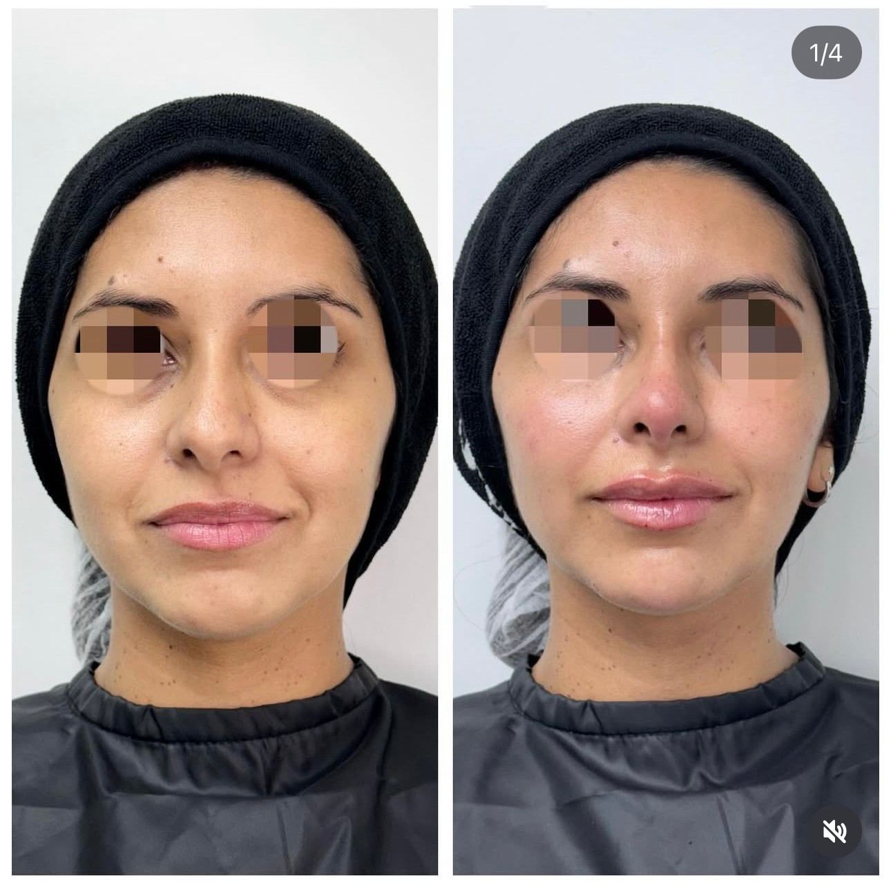 Full Face con ácido hialurónico