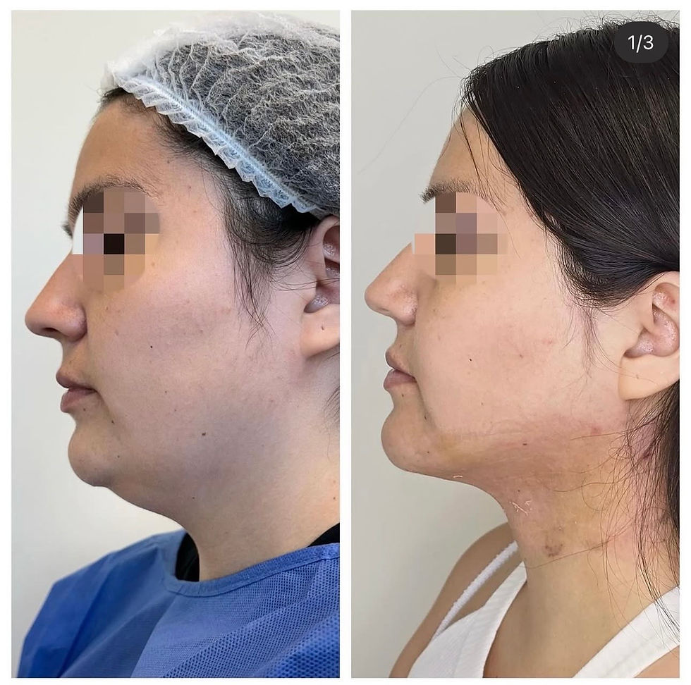 Miniatura: Liposucción de papada + Contorno mandibular