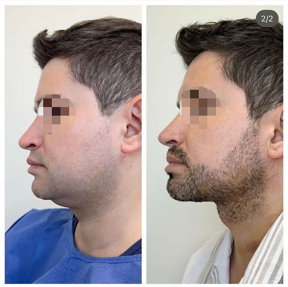 Miniatura: Liposucción de papada + Contorno mandibular