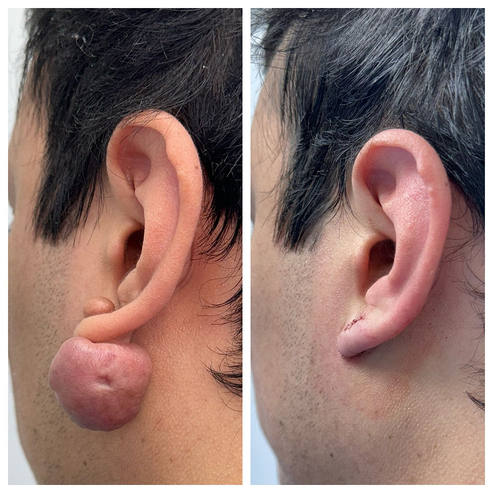 Miniatura: Extracción Queloide