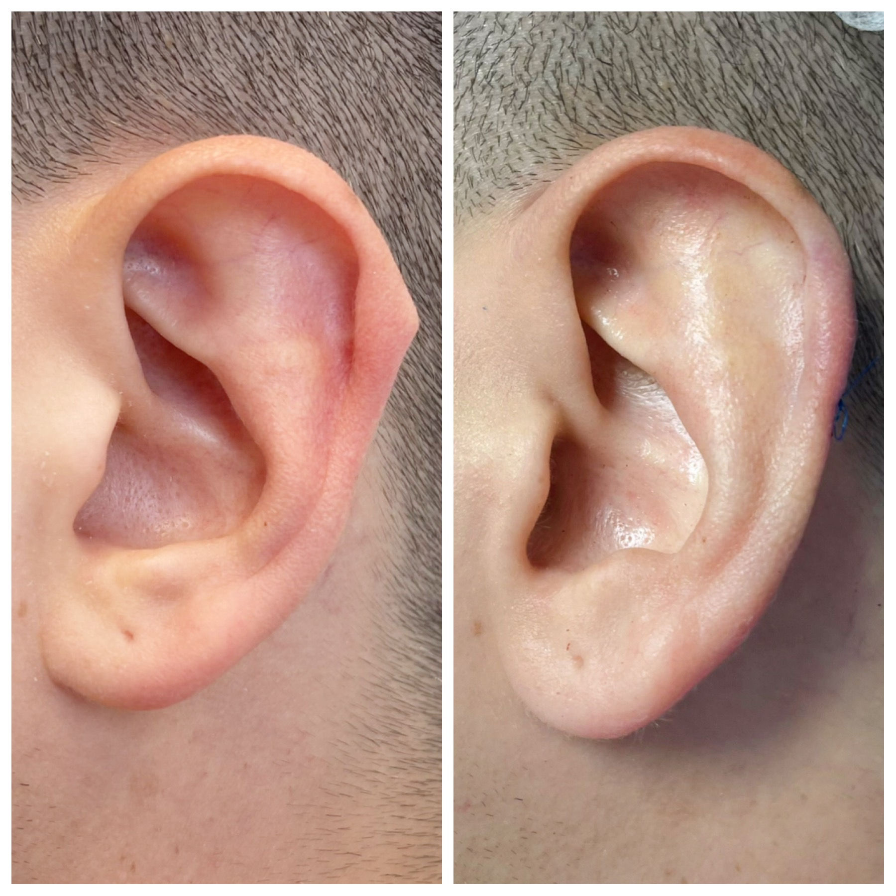 Plastía auricular