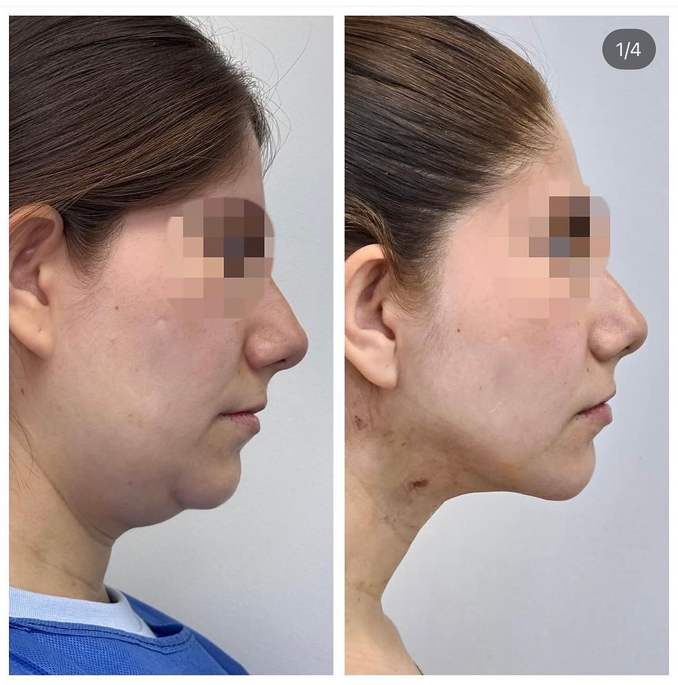 Miniatura: Liposucción de papada + Contorno mandibular