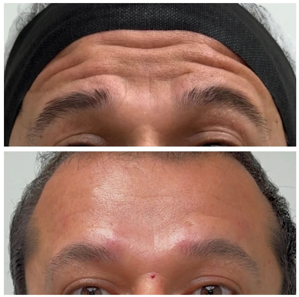 Miniatura: Toxina botulínica