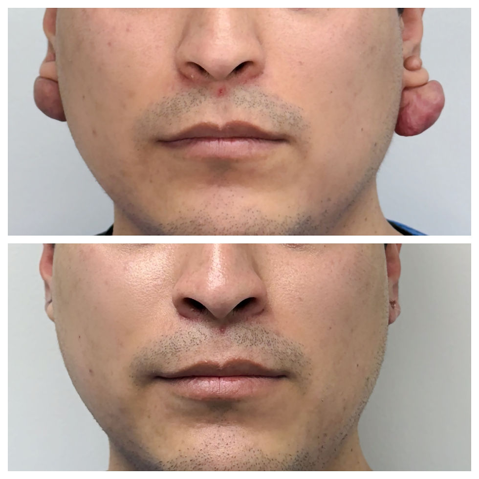 Miniatura: Extracción Queloide