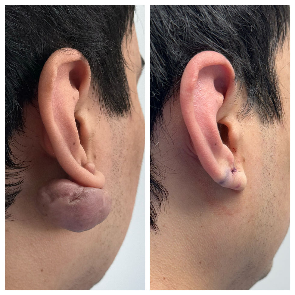 Miniatura: Extracción Queloide