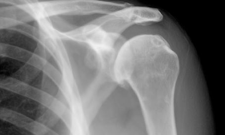 Shoulder xray