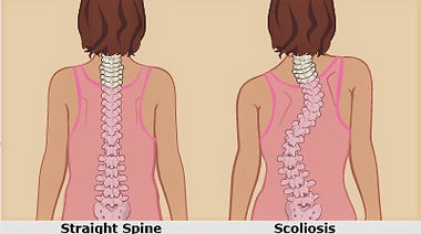 scoliosis vs straight edited.jpg