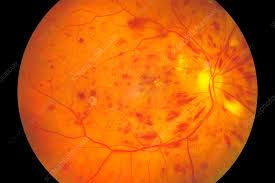 Διαβητική Αμφιβληστροειδοπάθεια Πώς επηρεάζει τα μάτια ο σακχαρώδης διαβήτης Οφθαλμίατρος Χανιά – Νίκος Βακαλής