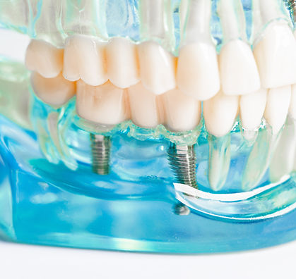dental implants and prosthetics