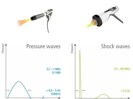 What is the difference between radial and focused shockwave therapy?