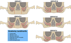 Classification of profiles for bone resoption post tooth loss