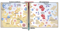 Medication related osteonecrosis of the jaws: model in aged mouse