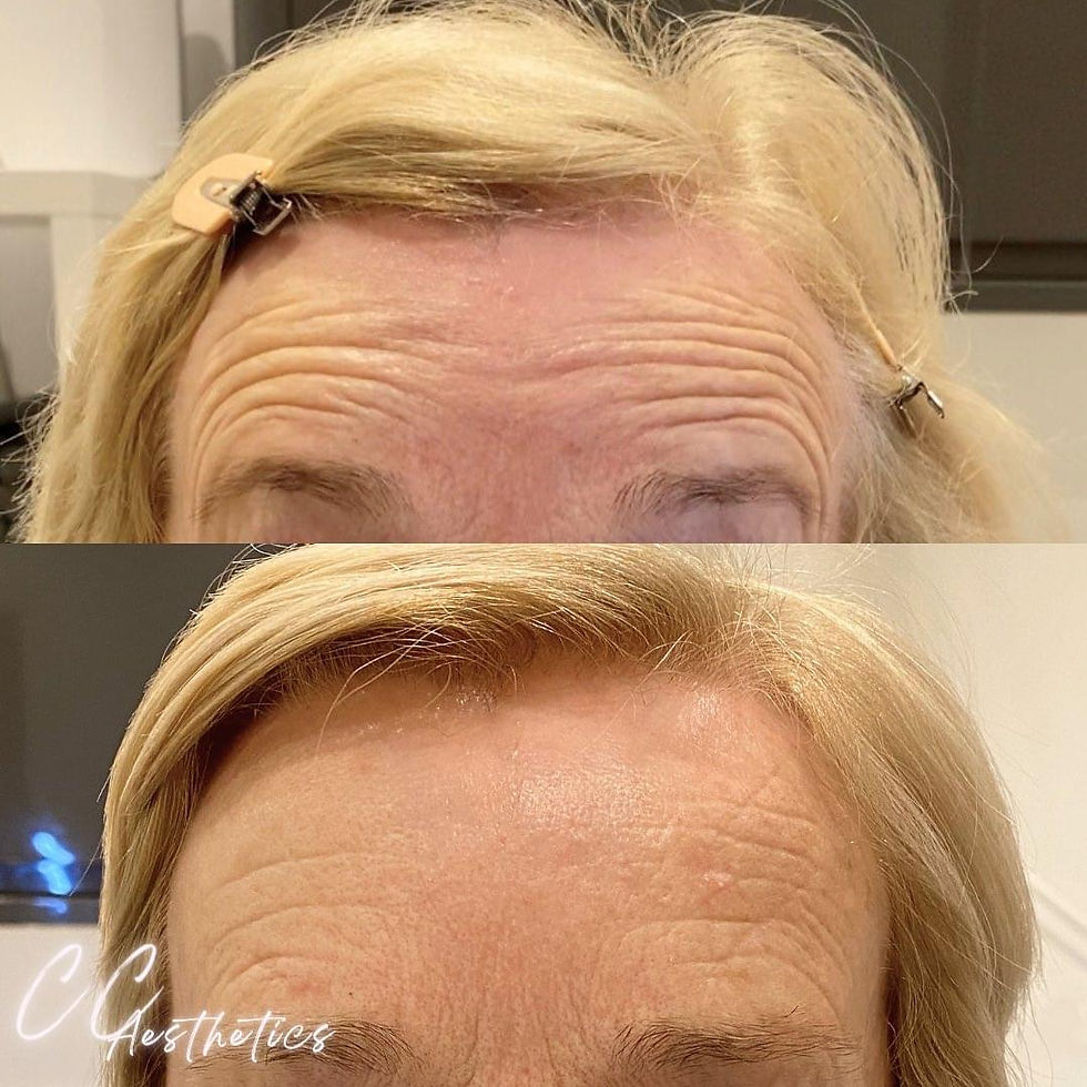Female Tox Before and After Forehead