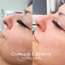 Before and after nose filler