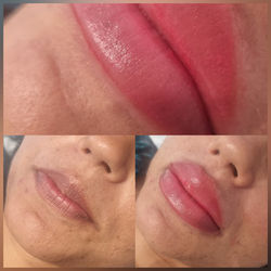 before and after lips