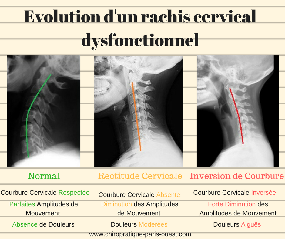 Comprendre et soulager sa névralgie cervicobrachiale