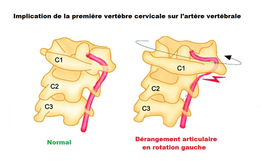 Vertiges, déséquilibres, tête qui tourne... Les vertèbres cervicales mises en cause