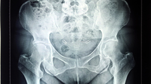 douleur sacro iliaque