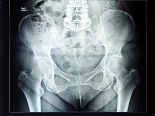 douleur sacro iliaque