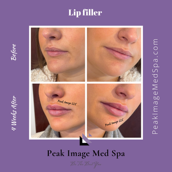 lip filler.PNG