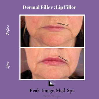 lip filler.PNG