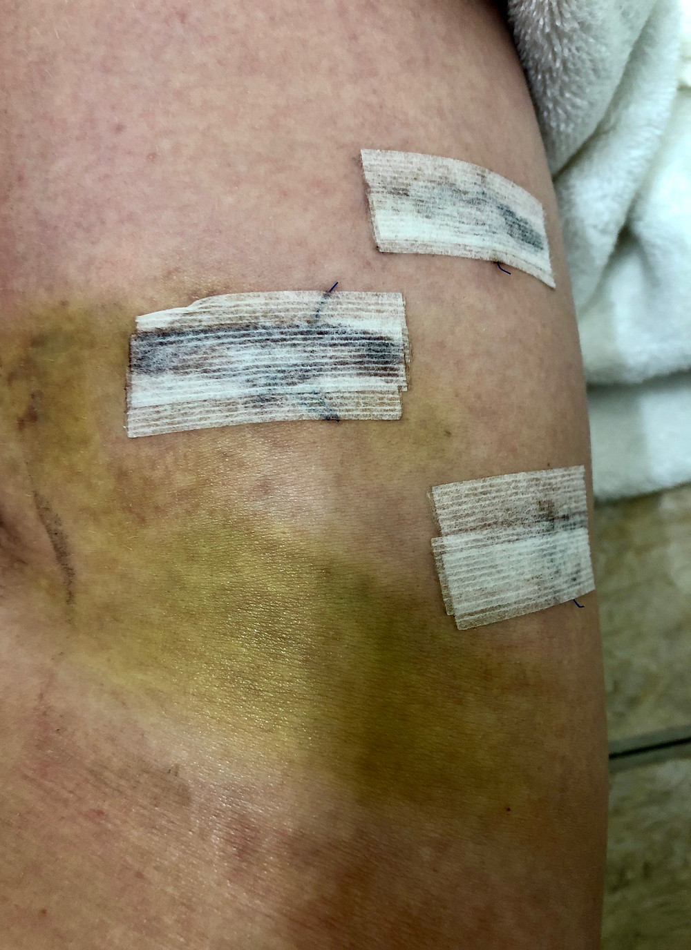 nasty! hip surgery a month before the white coat ceremony