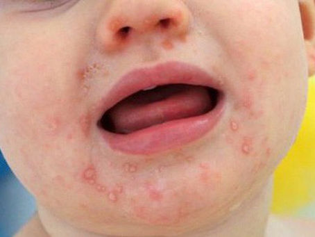 Bệnh tay chân miệng ở trẻ nhỏ là gì và các giai đoạn phát triển?