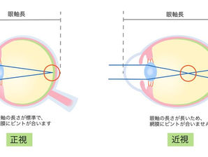近視度数の進行を遅らせる・防ぐ 取り組み(子供の場合)
