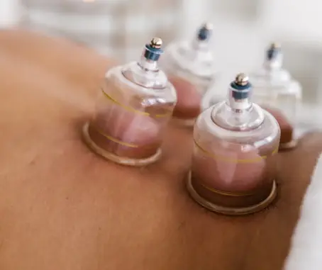 Cupping Therapy Explained: Benefits, Uses, Side Effects & Dry Cupping in Physiotherapy