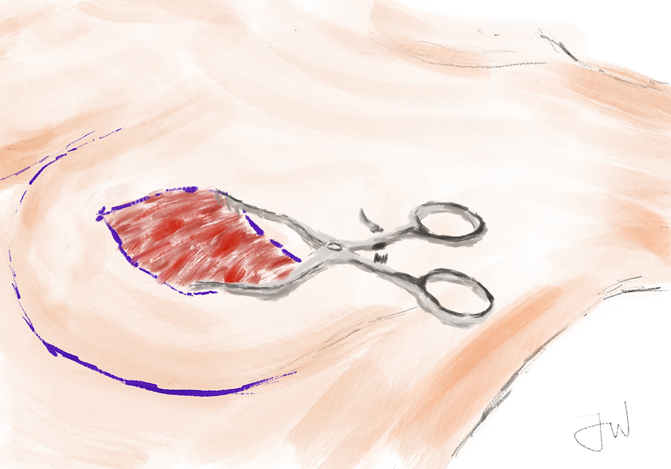 A retractor keeps the breast incision open as the team searches for arteries & veins that could be used to anastomose to the flap's own vessels. Artwork by John Winton.