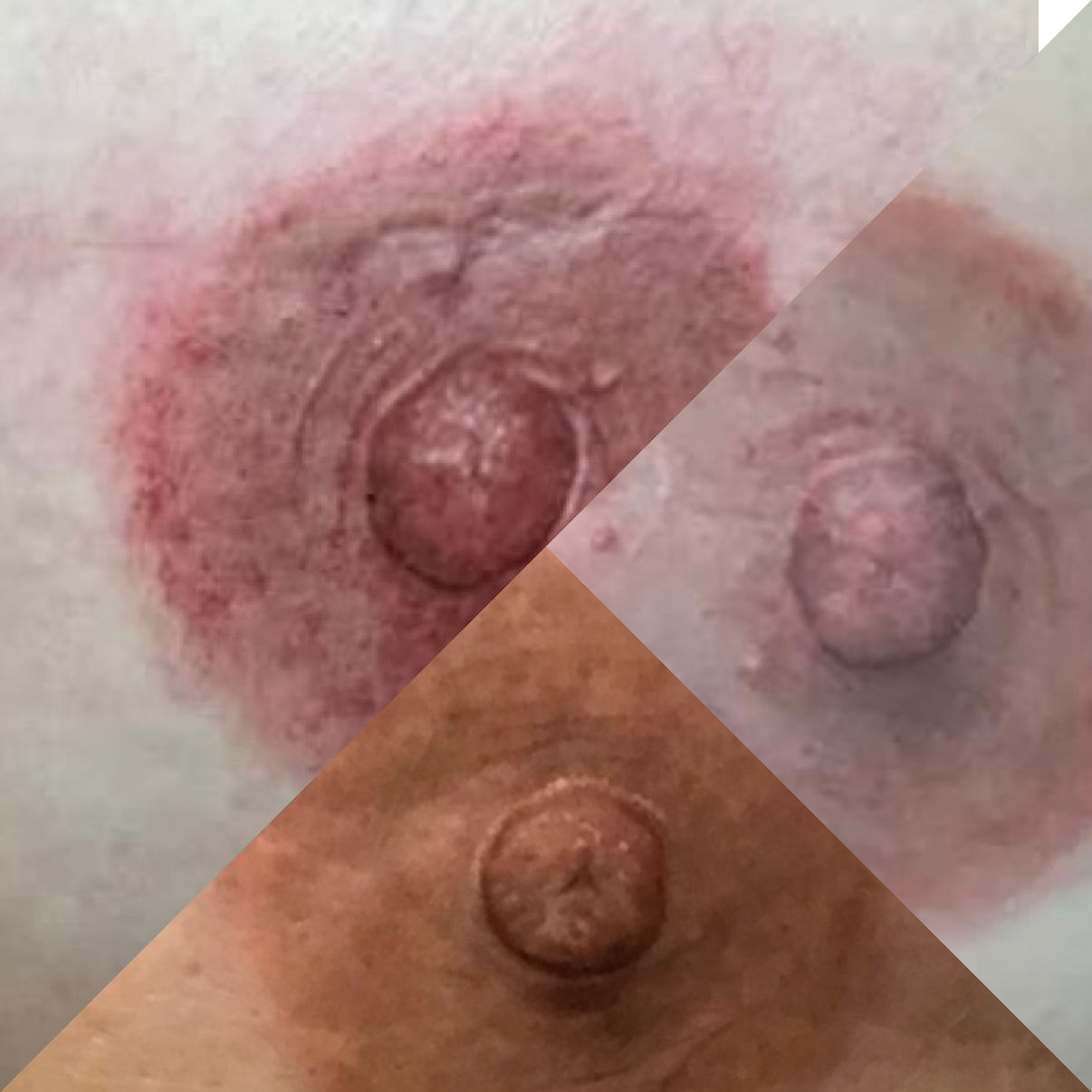 An Areola Tattoo is a specialized paramedical tattoo designed to recreate the natural look of the areola and nipple area, often after breast surgery such as mastectomy or reconstruction. The image typically shows soft, realistic shading with carefully blended pigments to match the client's skin tone.
Advanced 3D techniques are use to create depth, highlights, and subtle texture, giving the illusion of natural nipple even on flat skin. The overall appearance is delicate, symmetrical and customized. Focus on restoring confidence and completing the aesthetic outcome of breast reconstruction.