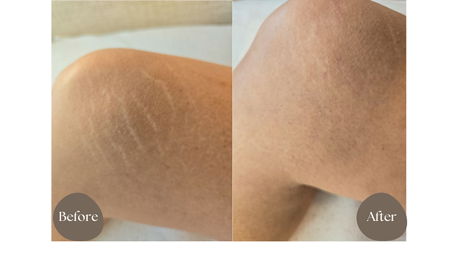 stretch mark treatment, before and after