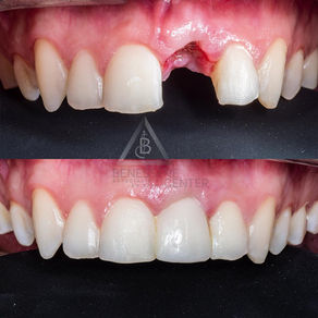 PUENTE FIJO ANTERIOR