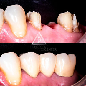 PUENTE FIJO DE CERAMICA