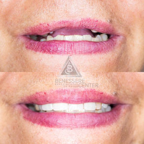 PROTESIS DENTAL ANTERIOR