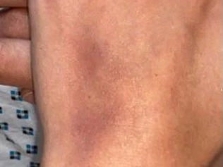 Polícia britânica prende suspeito de injetar substância desconhecida com agulha a mulheres em boates