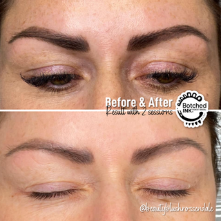 Laser Hair Removal Before & After 2.png