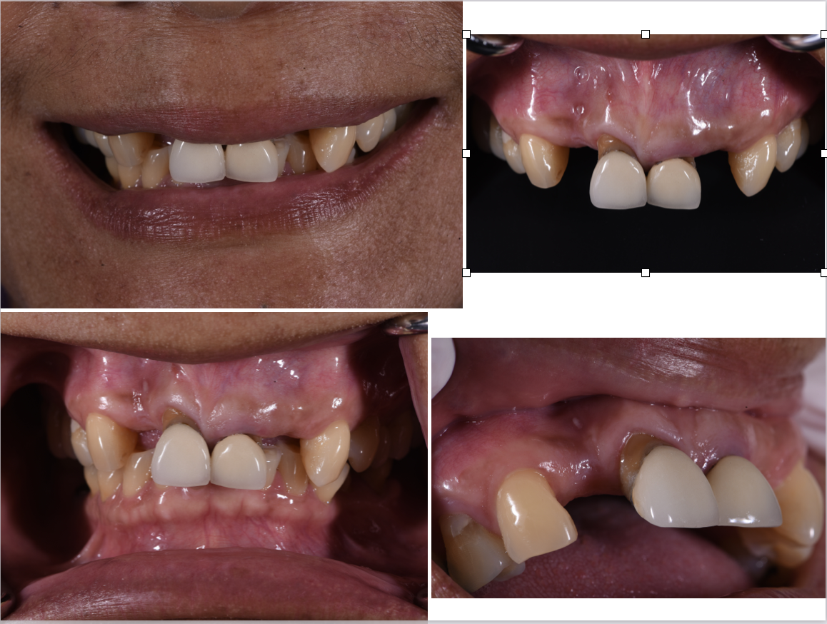 4 Upper Anterior Bridge with 2 implants content media