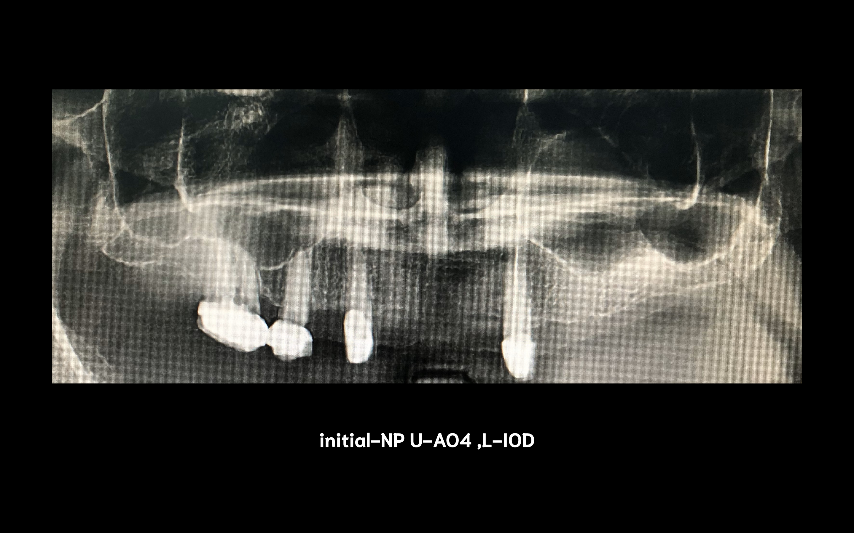 All on 4 for upper jaw, implant retained overdenture content media