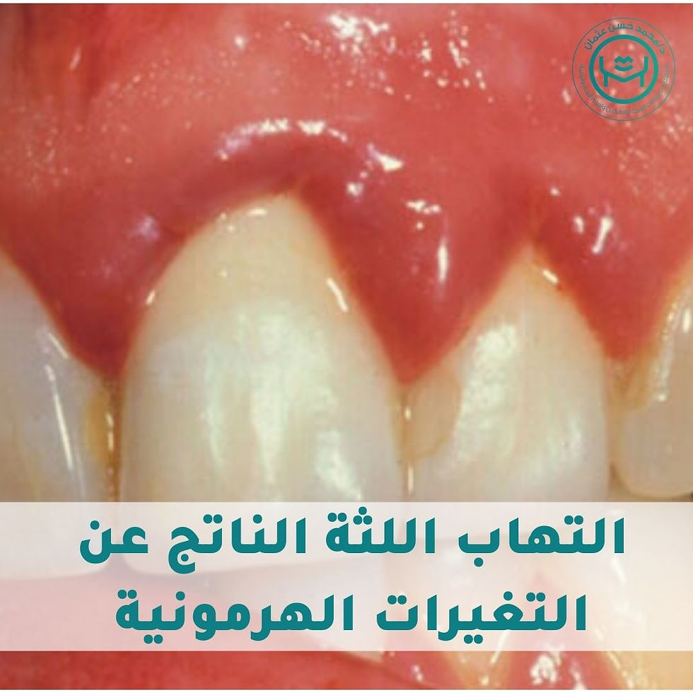 التهاب اللثة