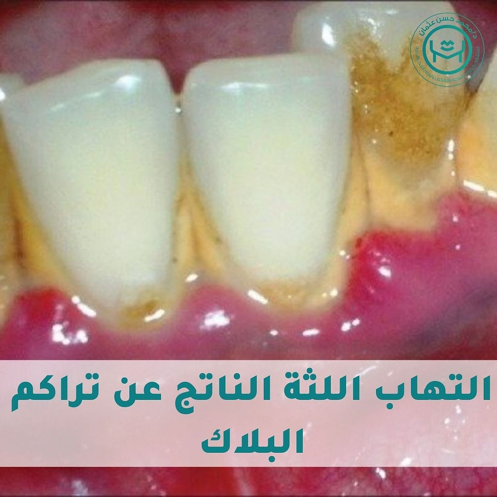 التهاب اللثة