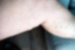 leg of woman with lipedema