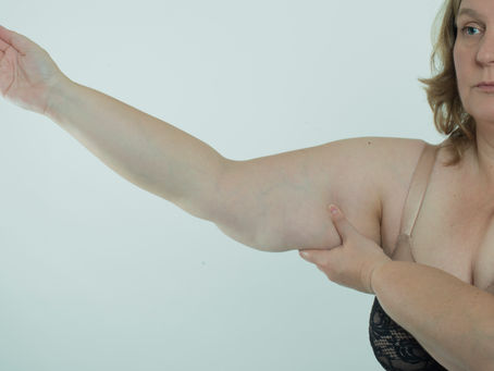 Woman with lipedema in a lace bra raises her arm, holding her upper arm with the other hand. Neutral expression, light background.
