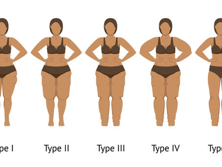 Five illustrations of women in brown underwear to represent the five types of lipedema, labeled Type I-V, show variations in body shape. All stand with hands on hips. White background.